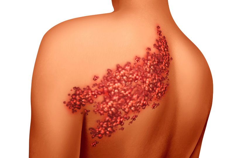 الحزام-الناري:-دليلك-الشامل--Shingles---Herpes-zoster-