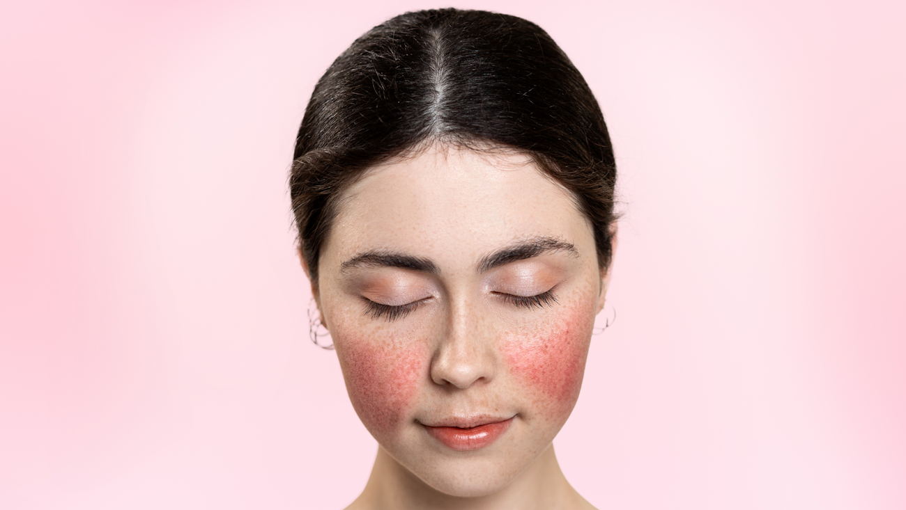 بشرة-وردية-أم-مرض-جلدي؟-الحقيقة-وراء-الوردية